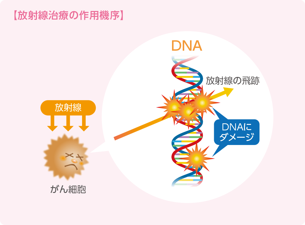 放射線療法の作用機序のイメージ
