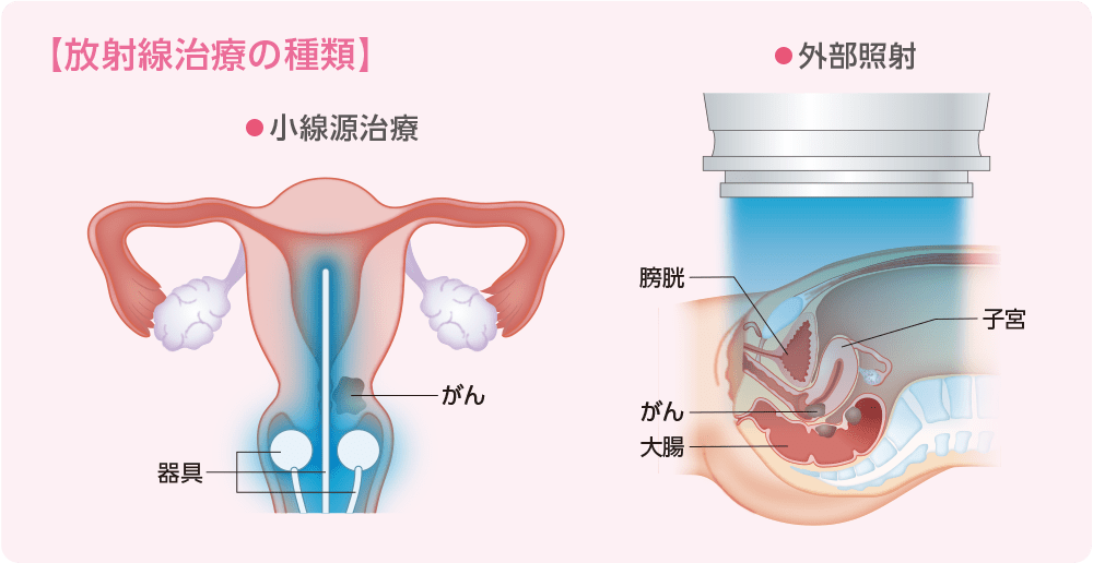 放射線療法の種類のイメージ
