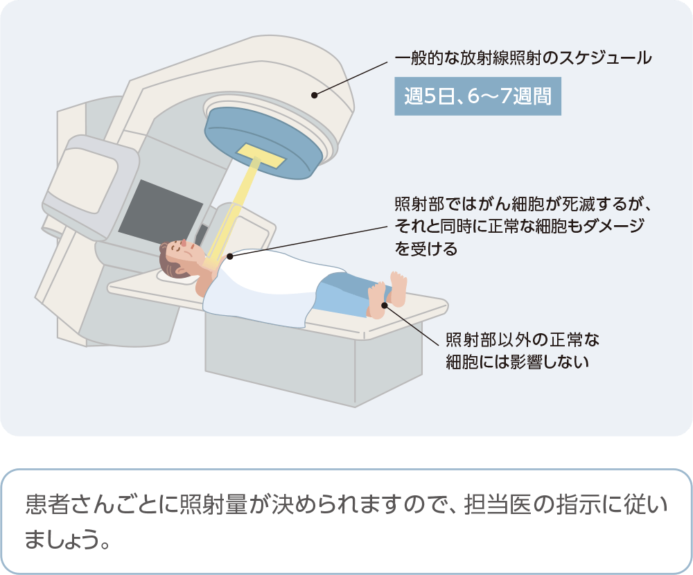 術後補助療法で用いられる放射線治療